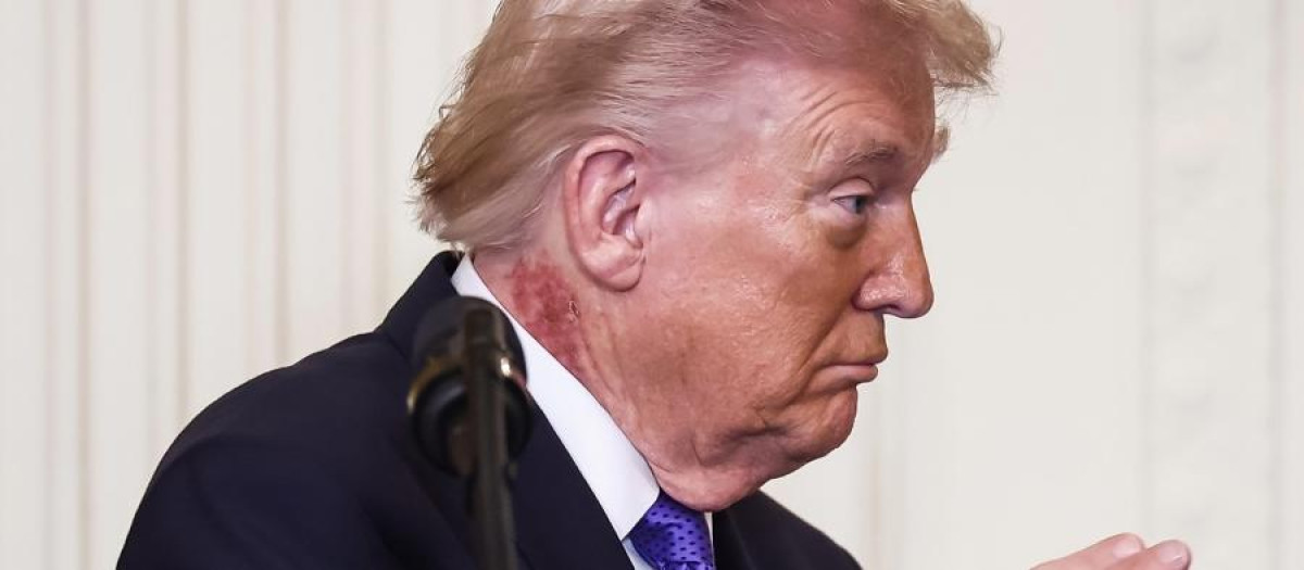 Donald Trump con  un sarpullido en el cuello