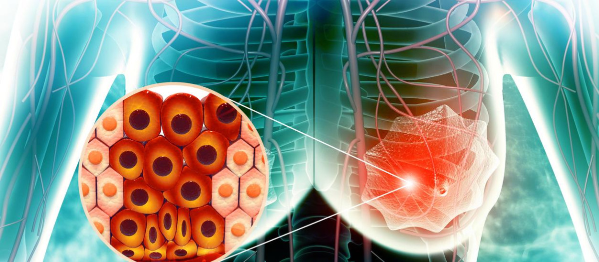 Cáncer de mama