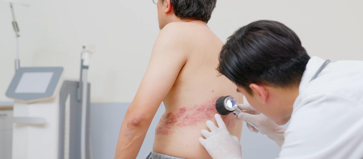 Un paciente con herpes zoster en consulta