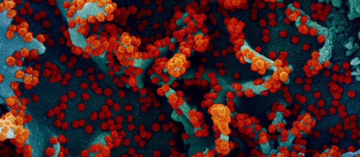 Micrografía electrónica de barrido coloreada de una célula infectada con SARS-CoV-2