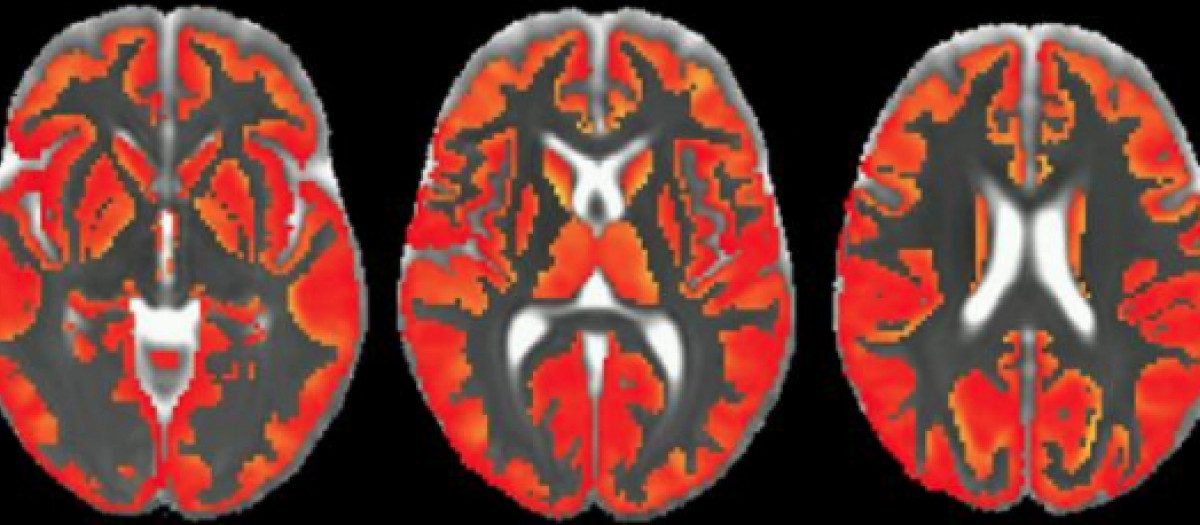 Inflamación cerebro