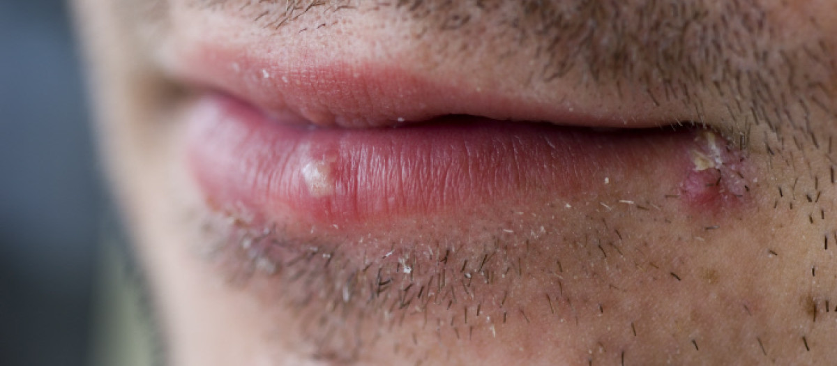 El herpes labial se propagaría con la "invención" del beso.