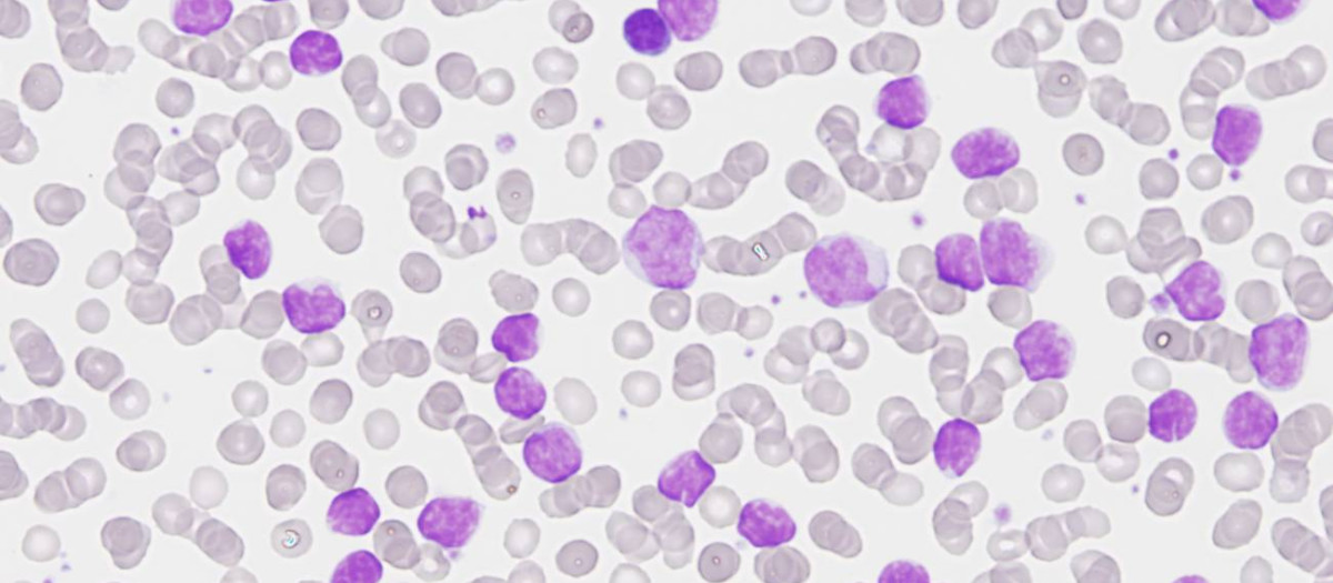 Completado el mapa genómico de la leucemia linfática crónica