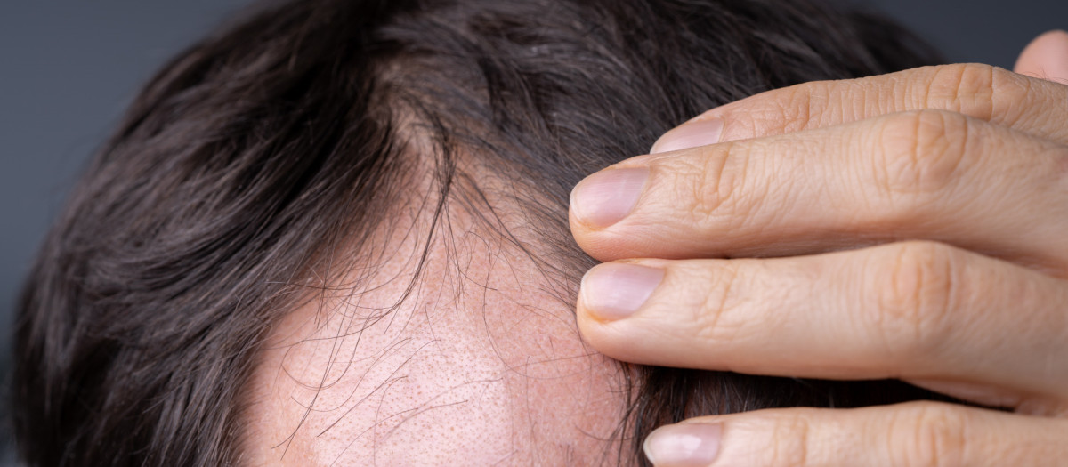 Close-up Of Young Man Checking Hairline At Home.Man,Checking,Hairline,At,Home,man, checking, balding, hair, home, loss, hairline, scalp,man, checking, balding, hair, home, loss, hairline, scalp,man, checking, balding, hair, home, loss, hairline, scalp, dandruff, lose, lice, head, receding, skin, hairloss, having, pain, sick, view, scrutiny, age, headache, body, losing, problem, men, front, care, painful, concern, feeling, examining, baldness, male, skincare, touching, adult, closeup, wellbeing, mid, indoors, caucasian