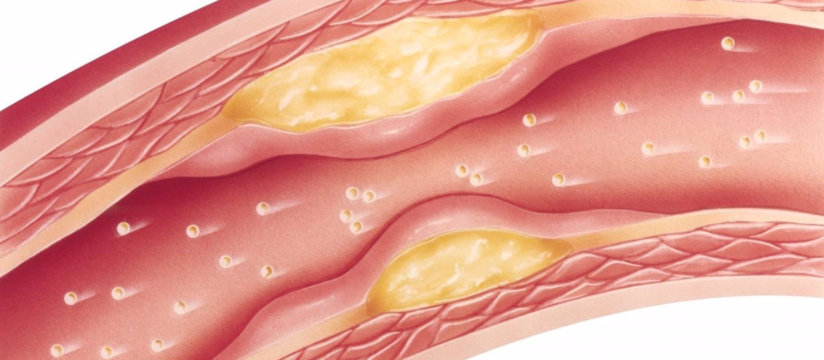 Adherencias en las arterias provocadas por el colesterol
