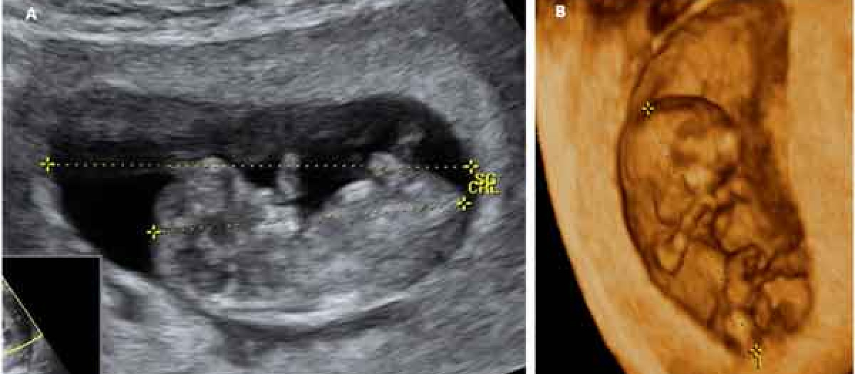 Ecografía en 2D y 3D de un embarazo de 10 semanas
