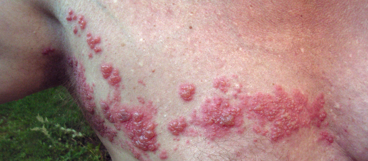 Herpes Zoster o culebrilla