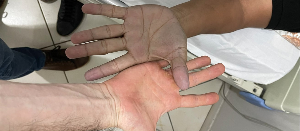 Mano azul comparada con una mano normal