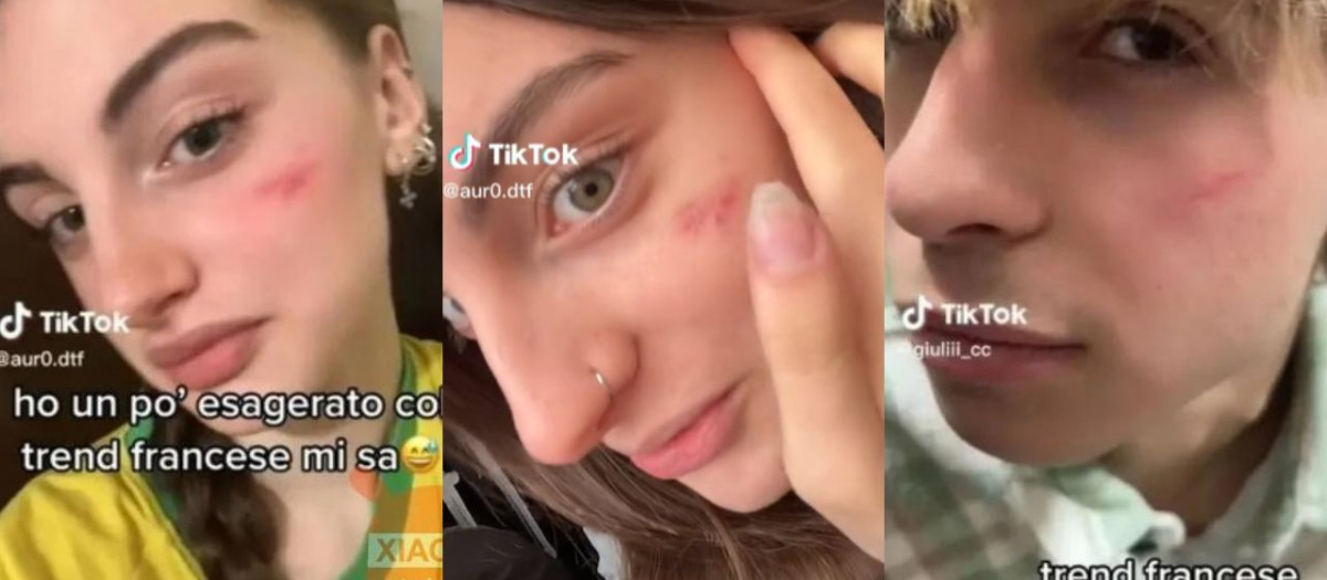 Varios jóvenes muestran su 'cicatriz francesa' en vídeos de TikTok