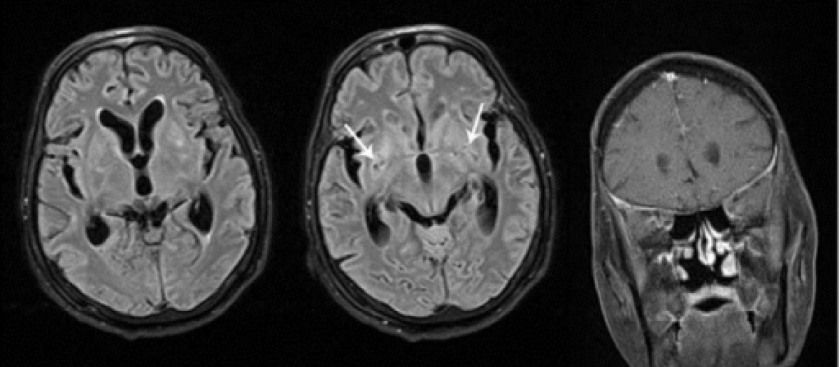 meningitis fúngica