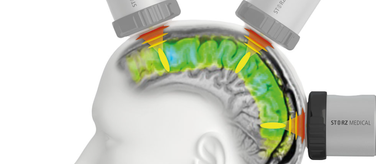 Tratamiento contra el alzheimer