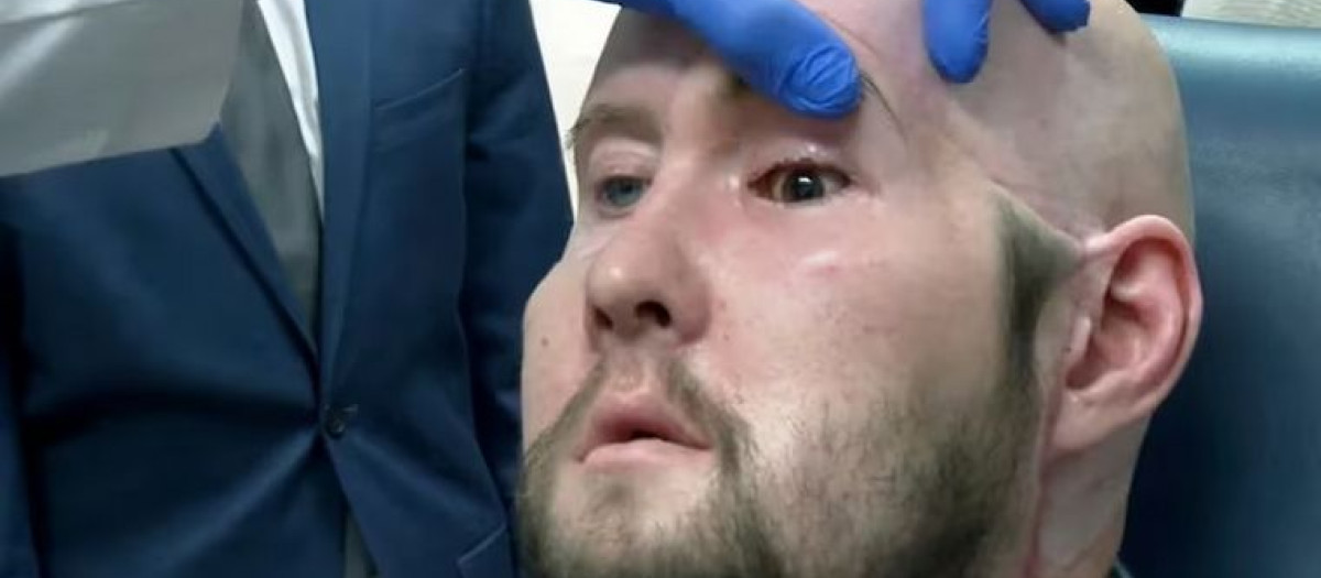 Hombre que ha recibido el primer trasplante de ojo