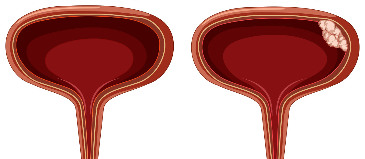 Ilustración de tumor de vejiga