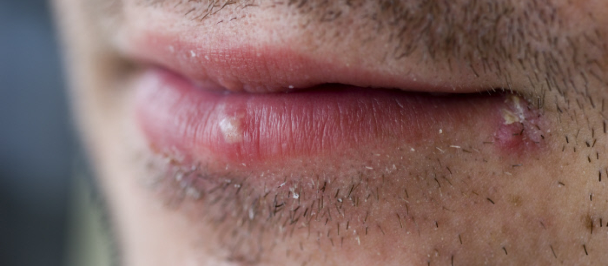 Herpes labial