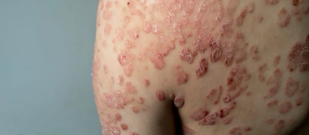 Paciente con psoriasis