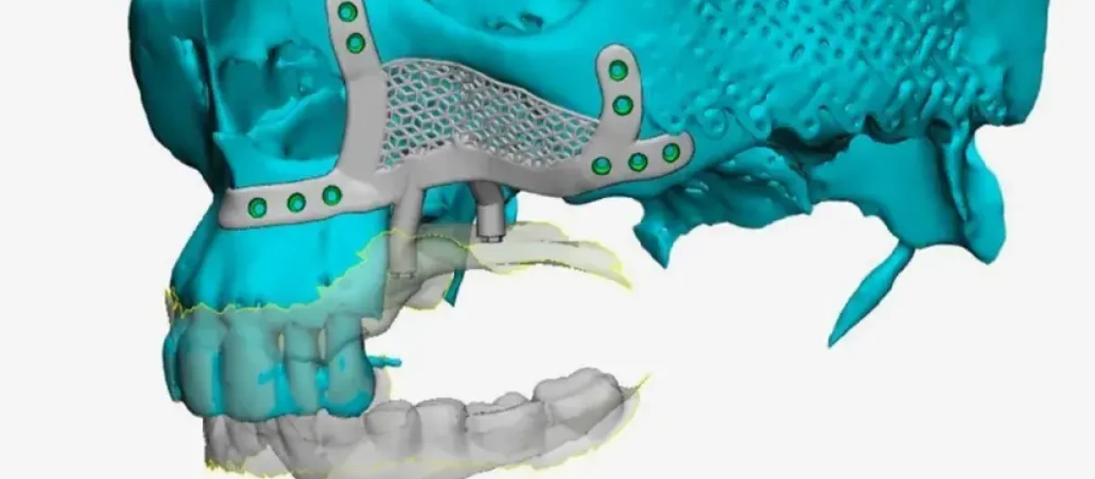 Implantes dentales subperiósticos