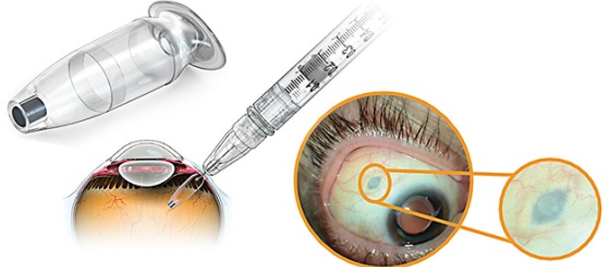 Dispositivo intraocular de dispensación