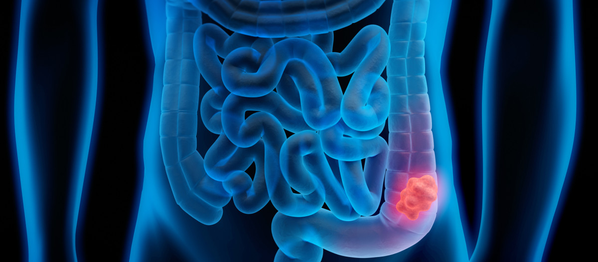 Medical illustration of Colorectal Cancer