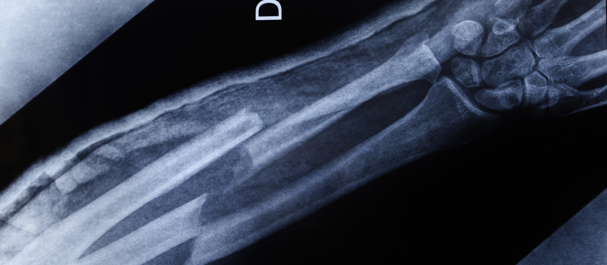 Imagen de rayos X de un brazo fracturado
