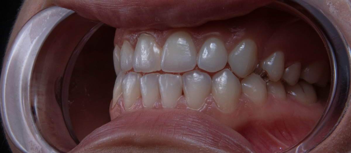 La periodontitis es una de las enfermedades bucodentales más serias