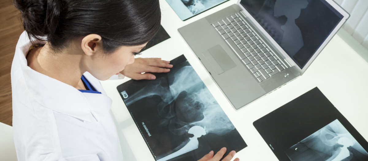 La artroplastia total de cadera es un tratamiento común para la osteoartritis de cadera