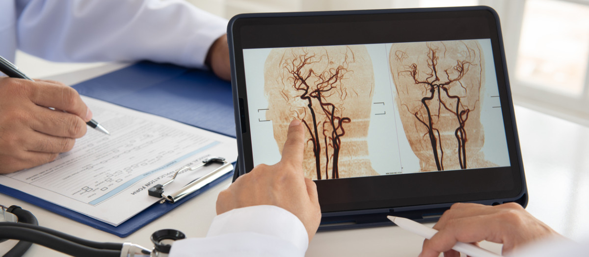 Doctor radiology team looking brain x-ray image mra for diagnose ischemic stroke or hemorrhagic stroke cerebrovascular disease at hospital.