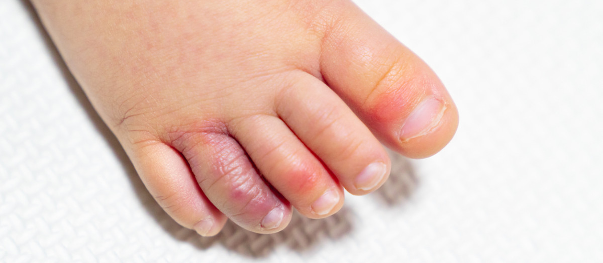 Una fotografía del pie de un niño pequeño con sabañones