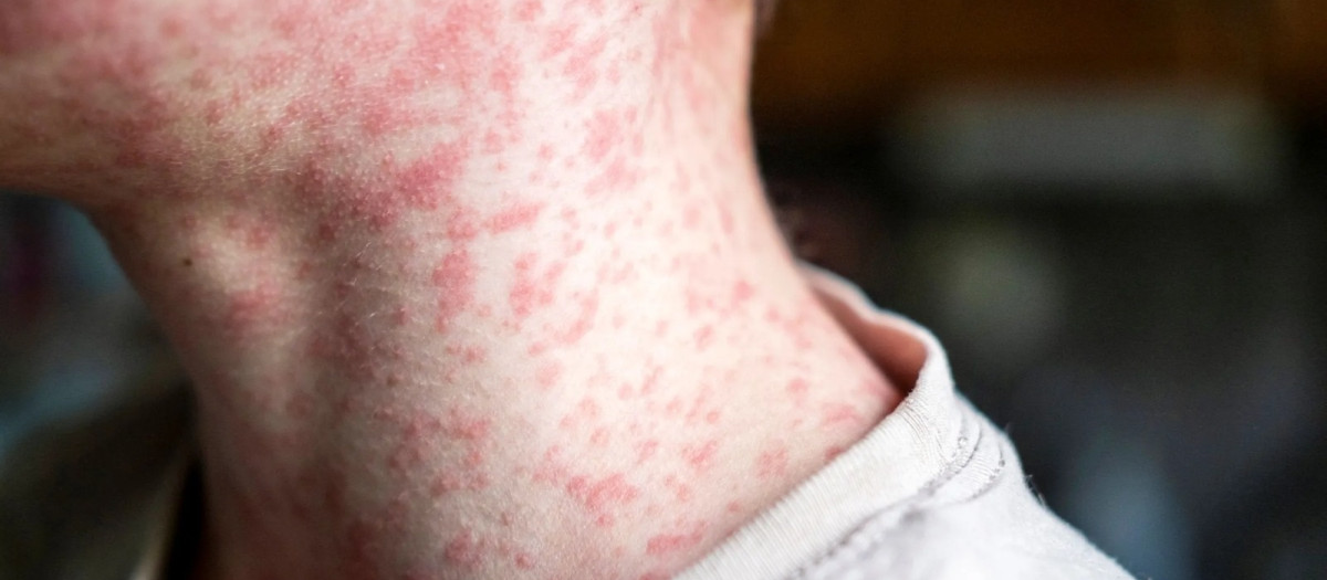 Imagen de una persona afectada por el sarampión