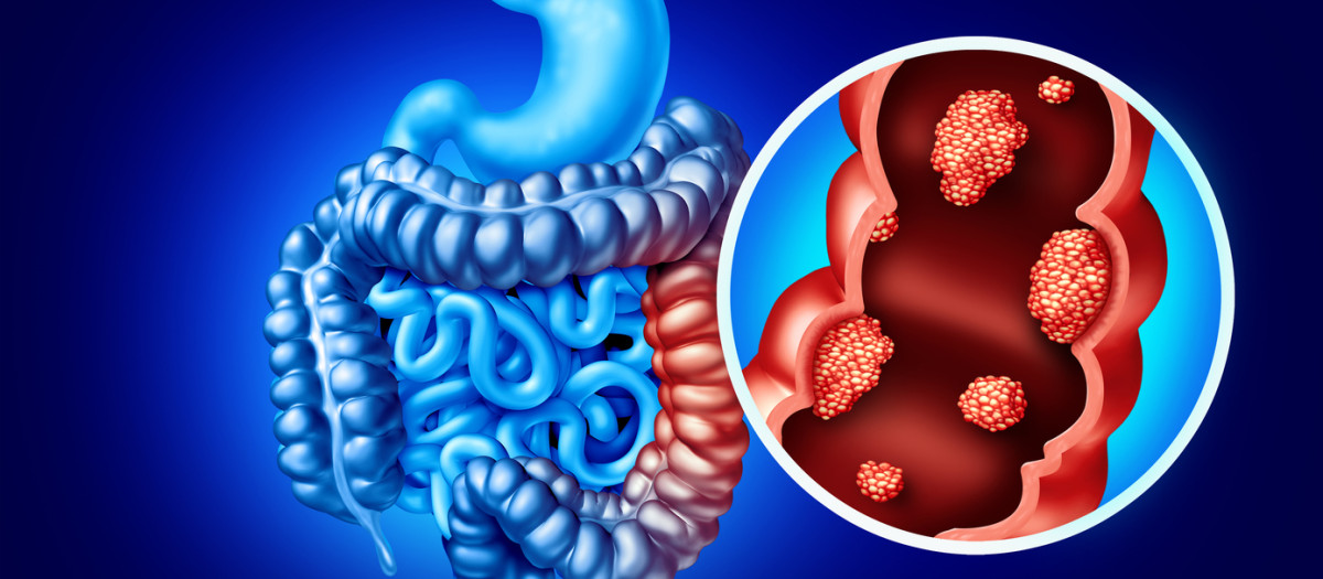 Cáncer de colon