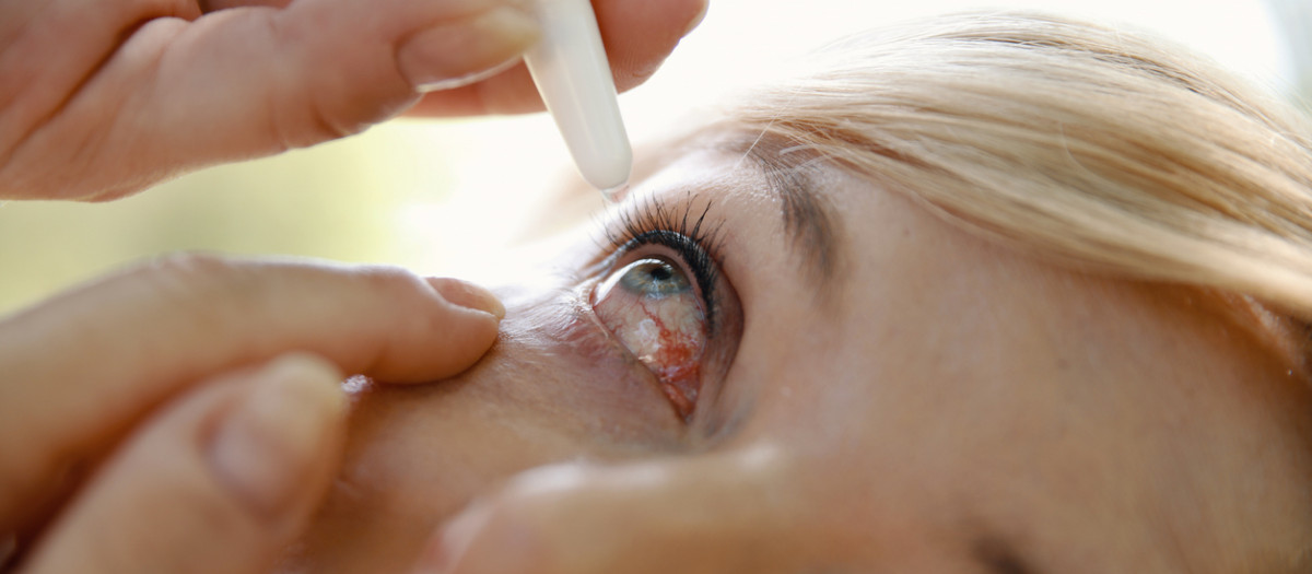 Conjuntivitis alérgica