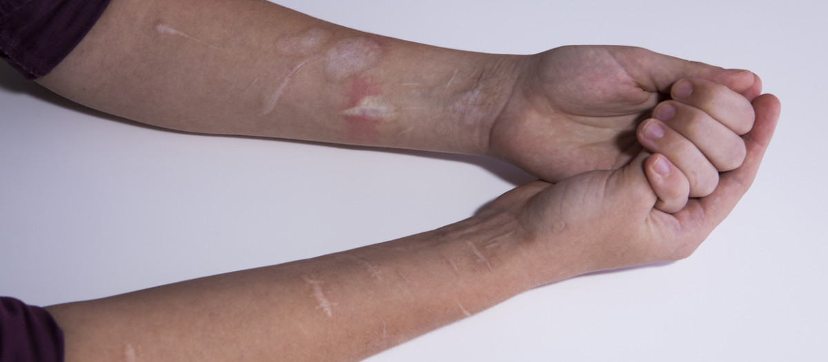 Los cortes y las quemaduras pueden surgir por una mala regulación de las emociones