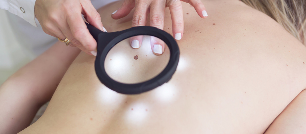 La vigilancia de lunares y manchas, esencial en el control de los melanomas