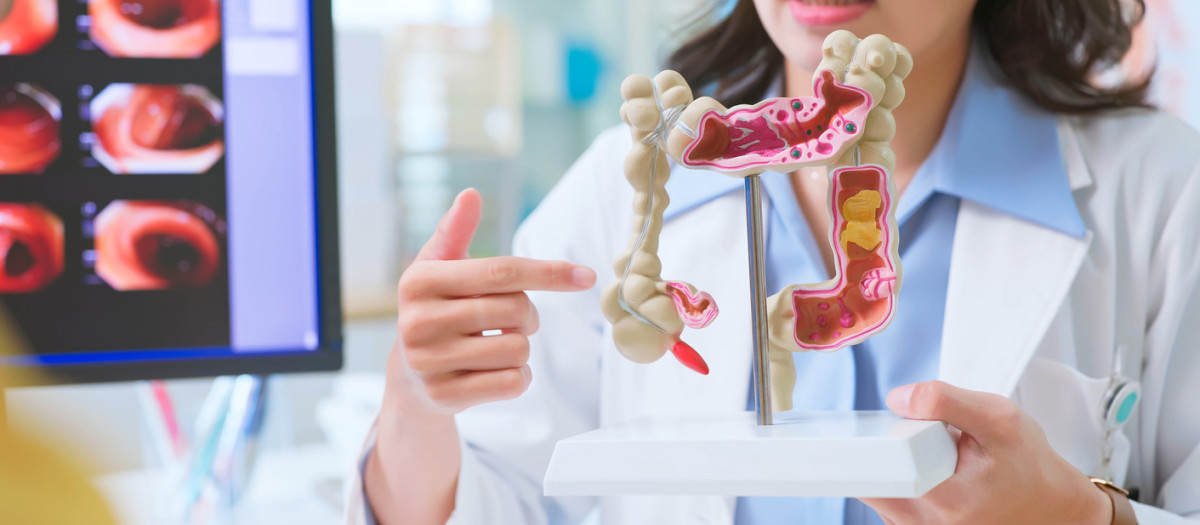 El cáncer de intestino es el tercer cáncer más común en el mundo