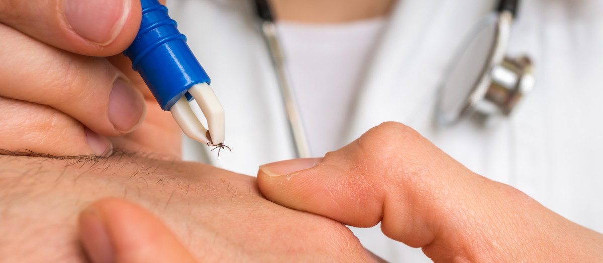 Un médico sacando una garrapata