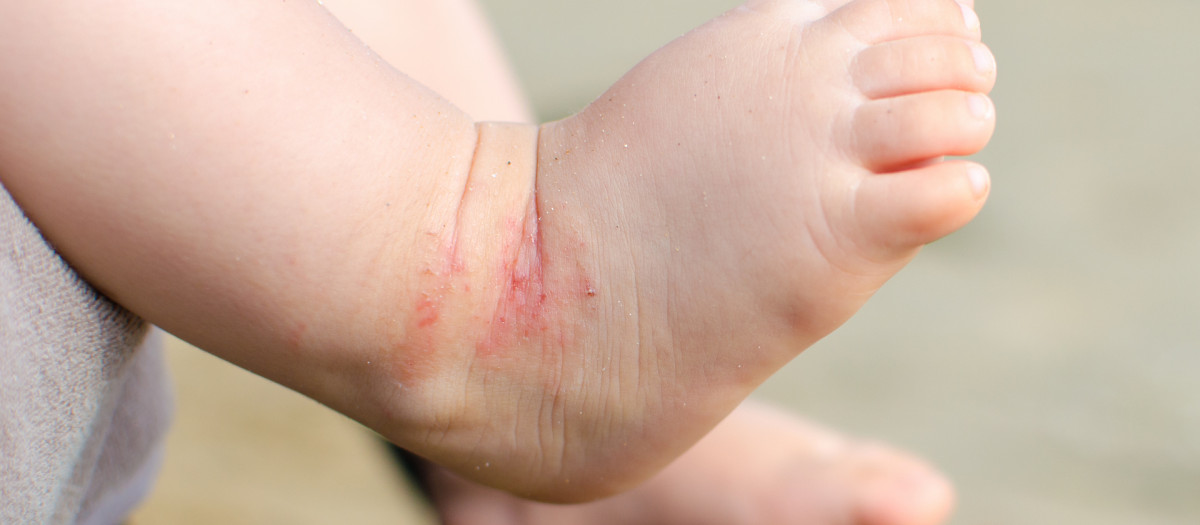 Dermatitis atópica