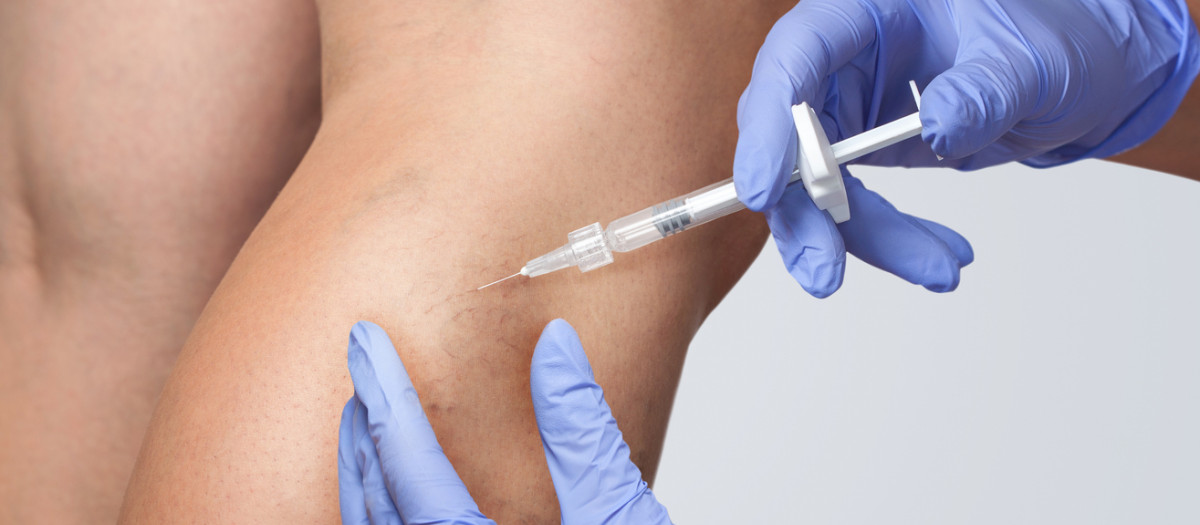 Varices en la pierna