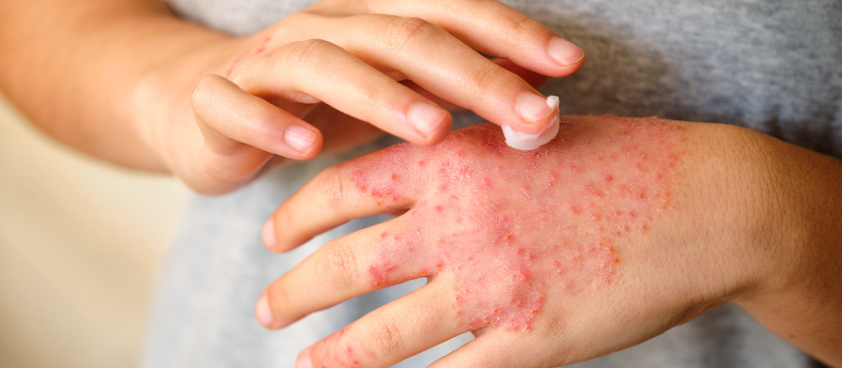 Dermatitis atópica