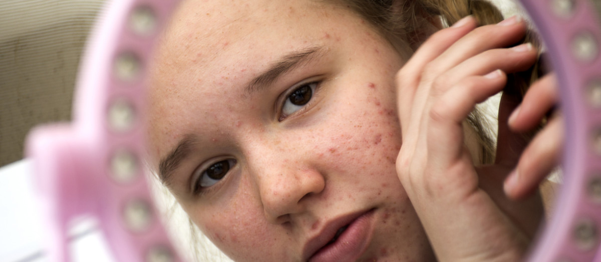 El acné genera problemas de autoestima en los adolescentes, señala Jane Nelsen