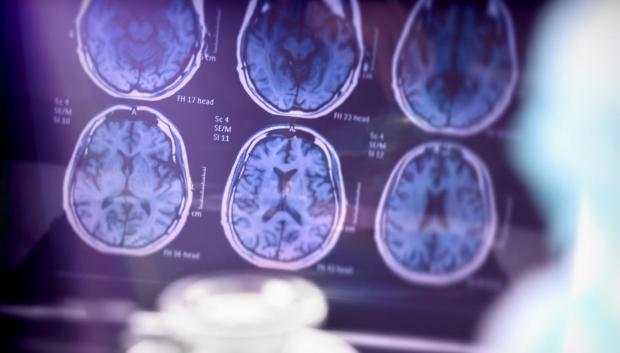 Análisis científico de la enfermedad de Alzheimer en el hospital