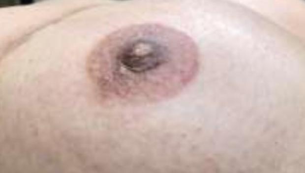 La micropigmentación paramédica de areolas es un tratamiento tras la reconstrucción de mama