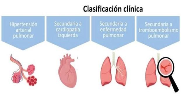 . La enfermedad afecta a los vasos del pulmon