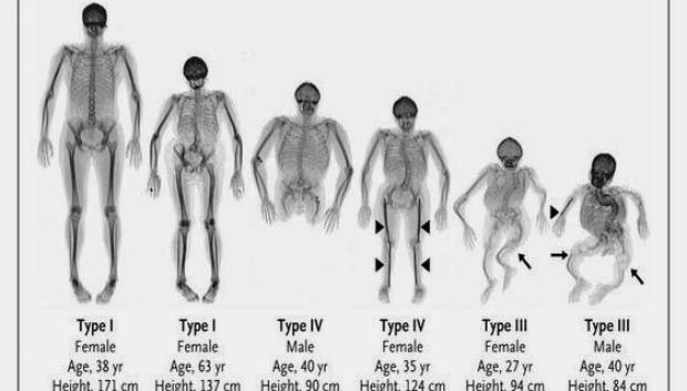 Tipos de Osteogénesis imperfecta