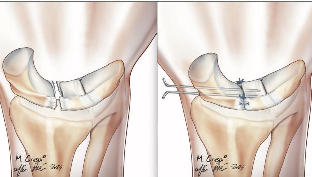 Imagen de cómo se procede a reparar la rotura del ligamento de la muñeca