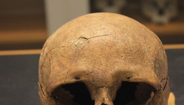 Del estudio del esqueleto vikingo: Un cráneo que muestra un traumatismo por objeto contundente con líneas radiales