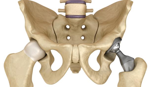 Hip replacement implant installed in the pelvis bone. Medically accurate 3D illustration