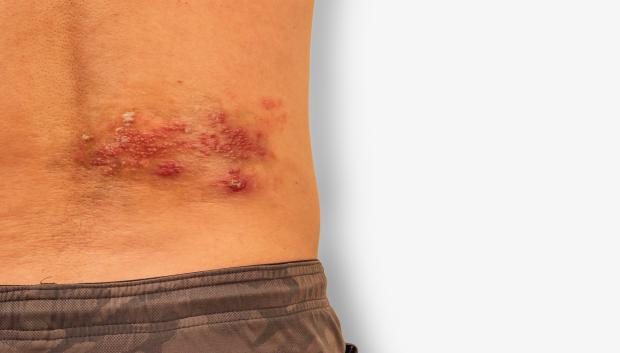 El virus varicela-zóster puede causar enfermedades graves más allá de la varicela y el herpes zóster