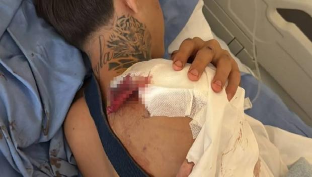 El joven a sufrido rotura de clavícula, entre otras lesiones