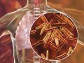 La tuberculosis es la segunda enfermedad infecciosa que más muertes causa tras la covid