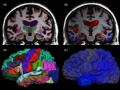 Estos escaneos cerebrales de MRI, tomados con seis meses de diferencia, muestran la progresión de un deterioro cognitivo leve a la enfermedad de Alzheimer