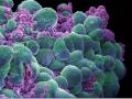 Células cancerígenas de cáncer de mama